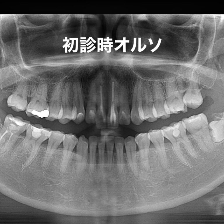 セラミック矯正
