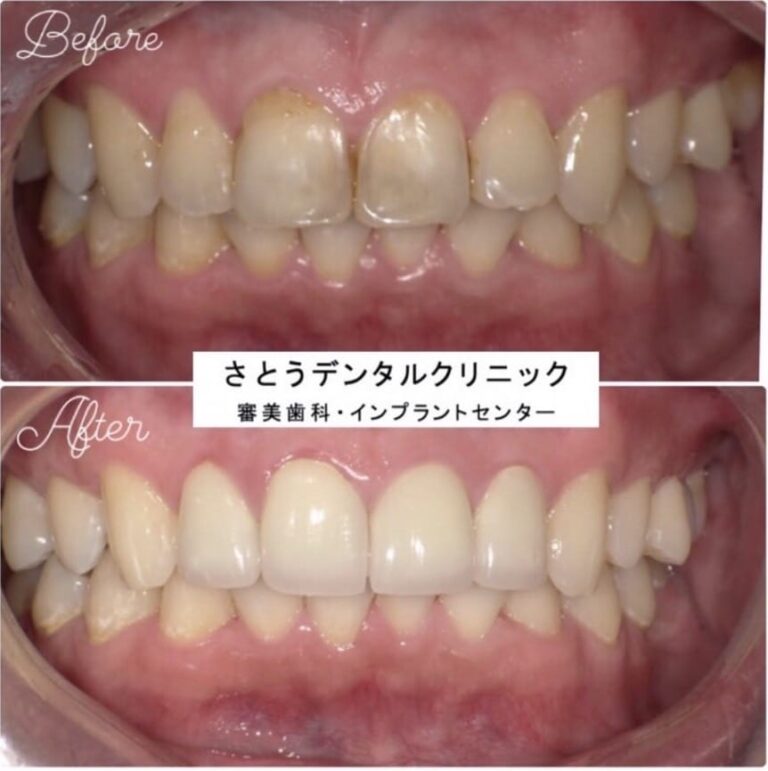 症例写真 セラミック矯正 / インプラント