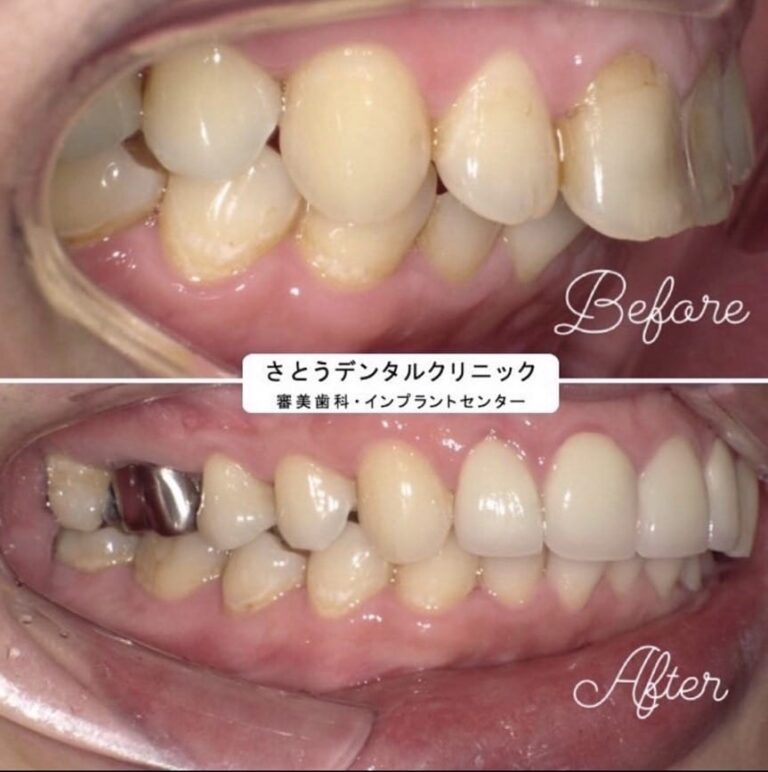 症例写真 セラミック矯正 / インプラント